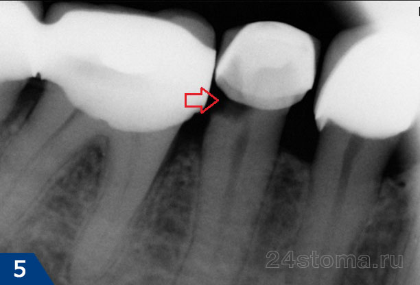 Кариозное разрушение зуба под коронкой показано стрелочкой