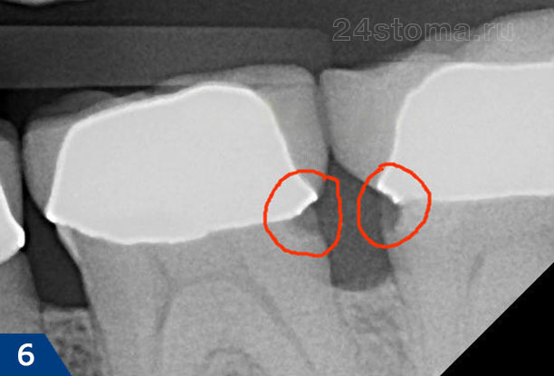 Кариес корней зубов у нижнего края коронок (со стороны межзубного промежутка)