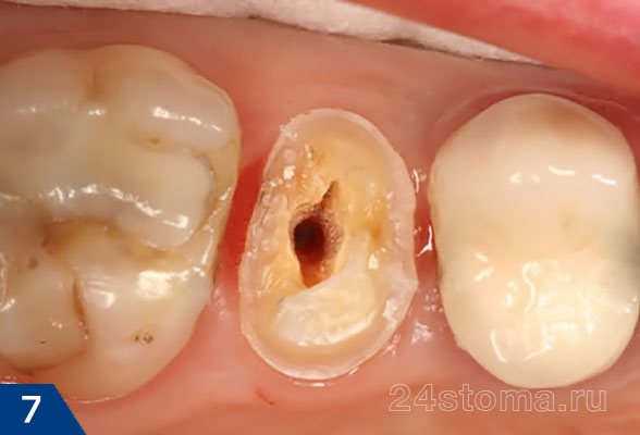 Исходная ситуация - коронковая частьзуба полностью разрушена, зуб готовится к протезированию коронкой