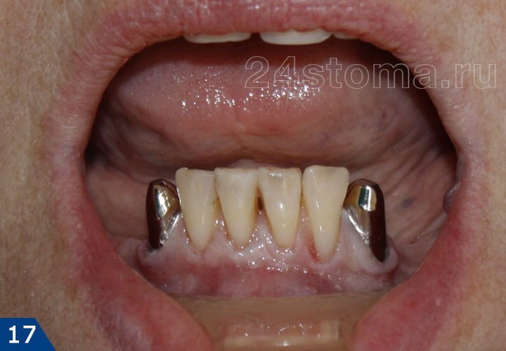 Металлические колпачки на опорных зубах под бюгельный протез