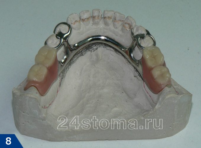 Бюгельный протез с кламмерной фиксацией на гипсовой модели зубов нижней челюсти пациента