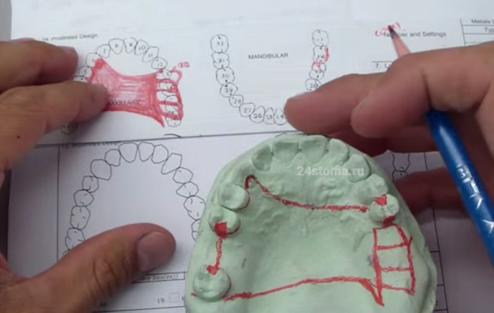 Зубной техник планирует каркас бюгельного протеза на верхнюю челюсть и места расположения кламмеров (производится на гипсовой модели зубов пациента)