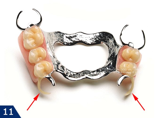 Комбинированный бюгельный протез (с двумя кламмерами, попадающими в линию улыбки, выполненными из н езаметного за зубах материала)