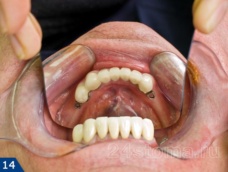 Металлокерамические коронки на зубах нижней челюсти (вид сверху; видны 2 замковых крепления)