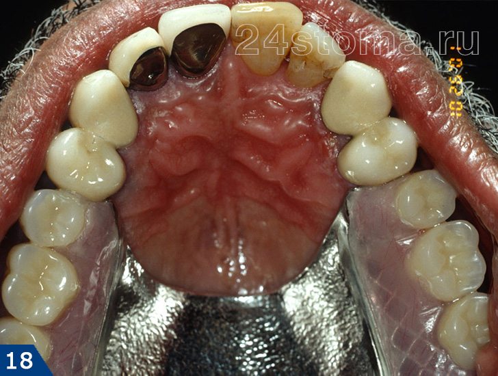 Бюгельный протез зафиксирован к зубам при помощи замковых креплений