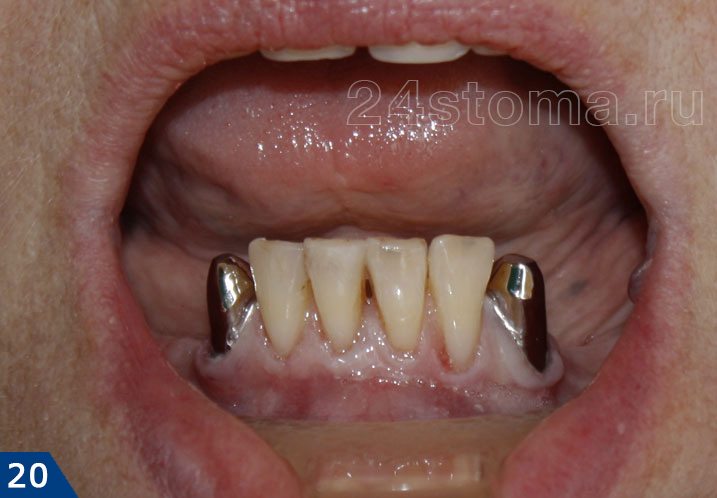 Металлические колпачки на опорных зубах