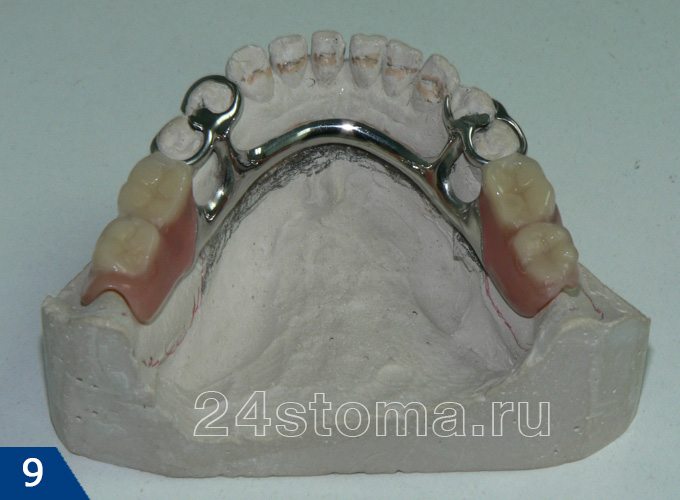 Бюгельный протез на нижнюю челюсть (на гипсовой модели зубов пациента)