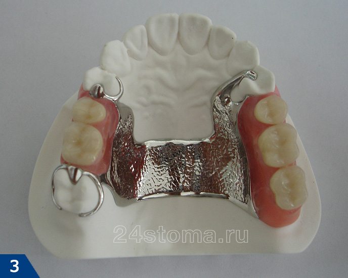 Бюгельный протез с рисунка 1 - на гипсовой модели зубов пациента