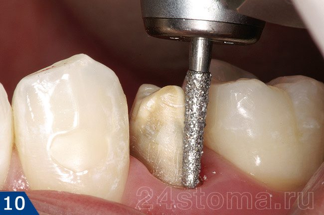 Процесс препарирования зуба под коронку