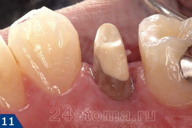 Вид зуба после препарирования