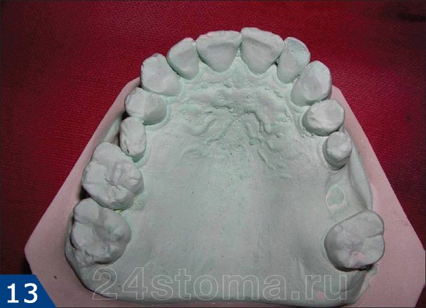 Гипсовая модель зубов пациента