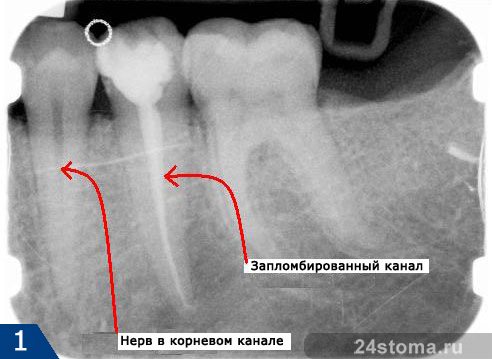 Вид запломбированных  и не пломбированных корневых каналов на рентгеновском снимке