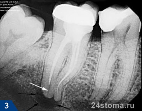Воспаление зуба под мостом лечение thumbnail