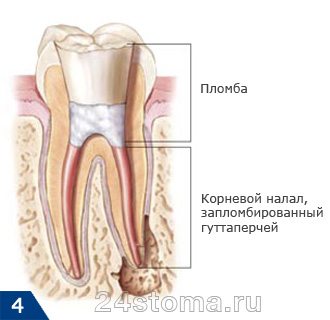 Пломбирование дефекта коронки зуба