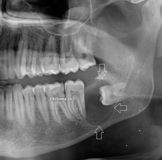 Фолликулярная киста нижней челюсти, причиной образования которой стал ретенированный зуб мудрости