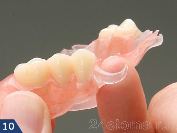 Кламмер нейлонового зубного протеза при близком рассмотрении