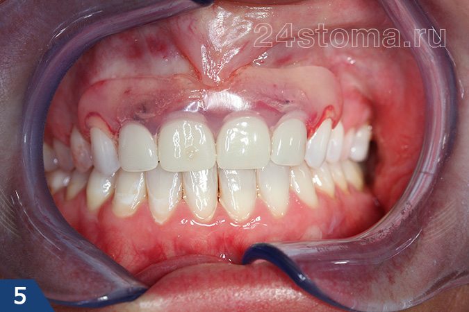 Нейлоновый зубной протез верхней челюсти (восполняющий 4 передних резца)