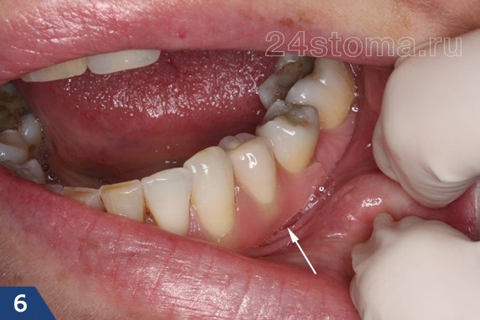 Нейлоновый зубной микро-протез на 1 зуб (указан стрелкой)