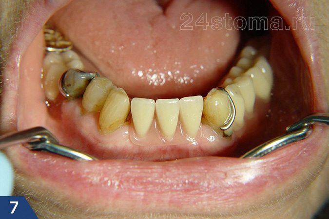 Вид традиционного зубного протеза с металлическими кламмерами, обхватывающими сохранившиеся зубы