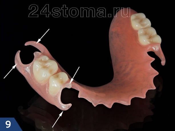 Кламмера нейлонового зубного протеза ( указаны стрелочками)