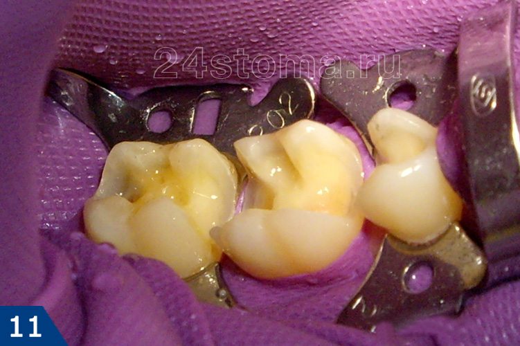Обработанные (отпрепарированные) под вкладки зубы