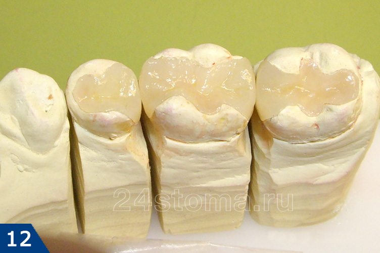 Готовые керамические вкладки на гипсовой модели зубов пациента