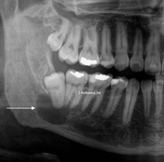 Фолликулярная киста нижней челюсти, причиной образования которой стал ретенированный зуб мудрости