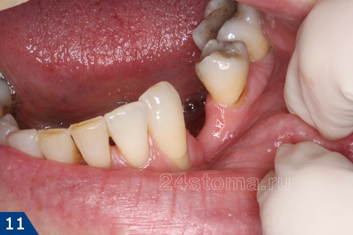 Протезирование дефекта 1-го зуба нейлоновым протезом (исходная ситуация)
