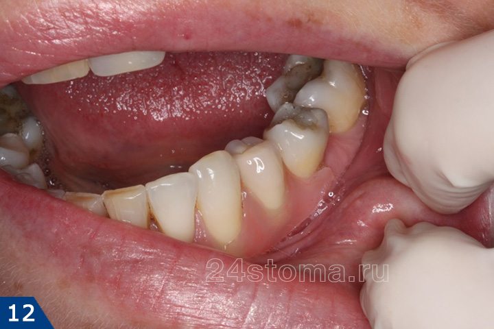 Протезирование дефекта 1-го зуба нейлоновым протезом (готовая работа)