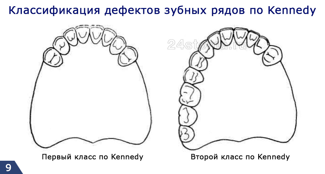 При каких отсутствующих зубах нельзя делать нейлоновые протезы