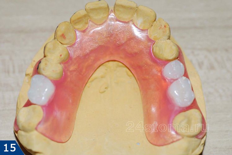 Нейлоновый протез, замещающий два включенных дефекта зубных рядов