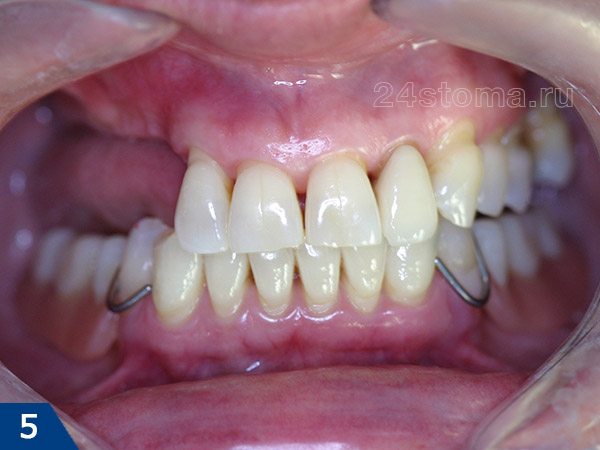 Вид частичного съемного протеза из пластмассы (металлические кламмеры хорошо видны на передней поверхности зубов)