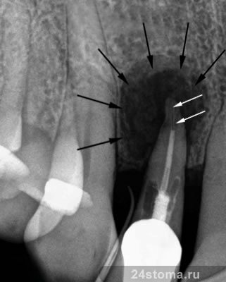 Киста корня зуба (вследствие некачественного пломбирования корневого канала при подготовке зуба к протезированию)