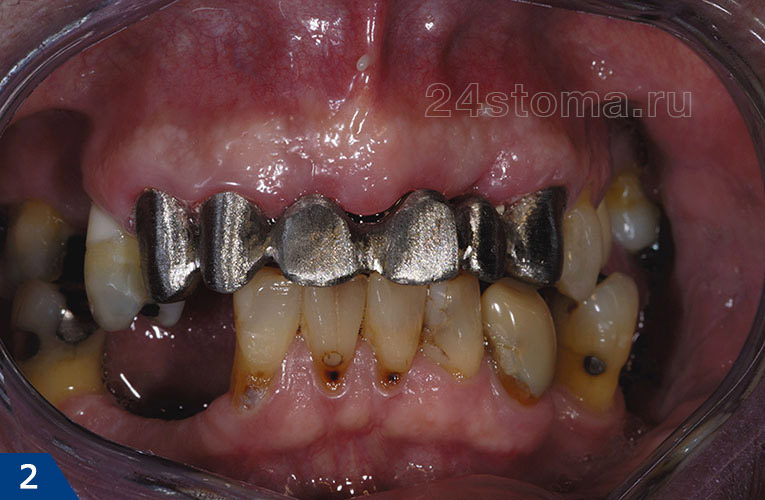 Примерка металлического каркаса во рту у пациента