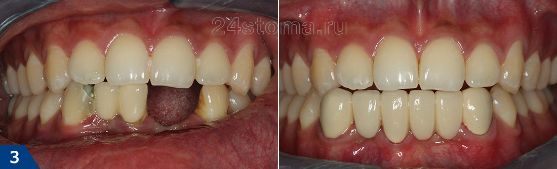 На 6 передних нижних зубов изготовлено 6 металлокерамических коронок фото до и после)