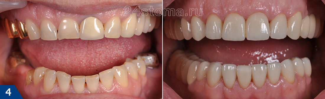 Установка металлокерамических коронок абсолютно на все зубы (фото до и после)