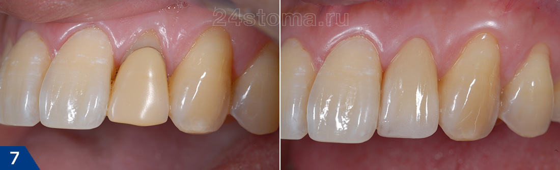 Одиночная керамическая коронка из фарфора на боковой резец (фото до и после), посмотрите как идеально сделаны цвет и прозрачность зуба