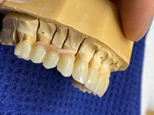 В данном случае циркониевые коронки «Multi-layer» были изготовлены на весь зубной ряд верхней челюсти. Там, где вы можете увидеть искусственную десну - циркониевый мостовидный протез.