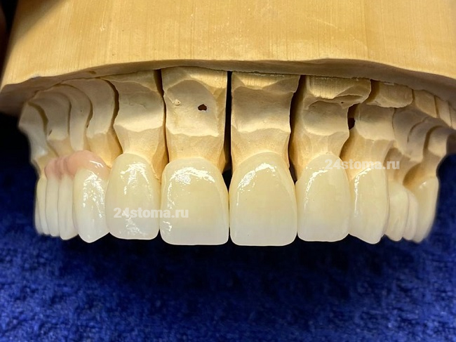 В данном случае циркониевые коронки «Multi-layer» были изготовлены на весь зубной ряд верхней челюсти. Обратите внимание на плавный градиент цвета и полупрозрачности.