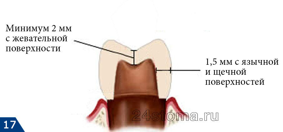 Схема сошлифовывания твердых тканей зуба под коронку