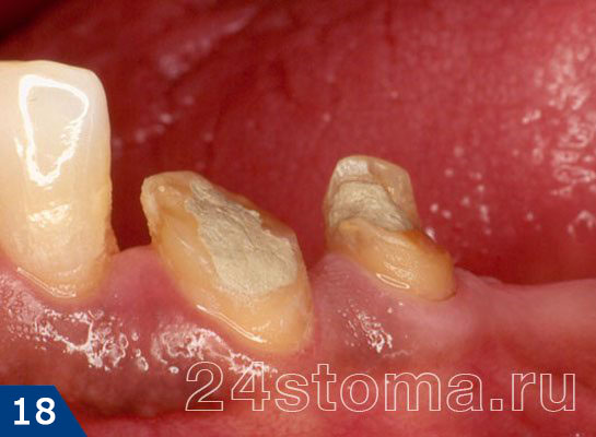 Исходная ситуация: зубы разрушены "под корень", каналы зубов запломбированы. Планируется протезирование металлокерамикой
