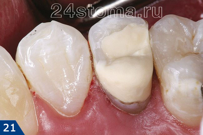 Восстановлена коронковая часть зуба при помощи пломбировочного материала