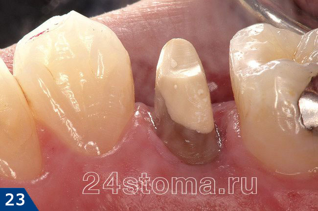 Вид культи зуба после препарирования зуба под коронку