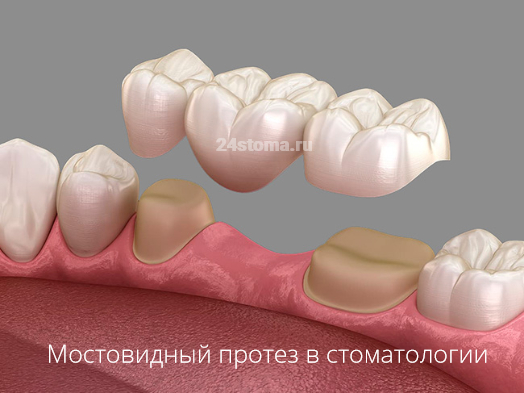 Фиксация мостовидного протеза на обточенных под коронки опорных зубах