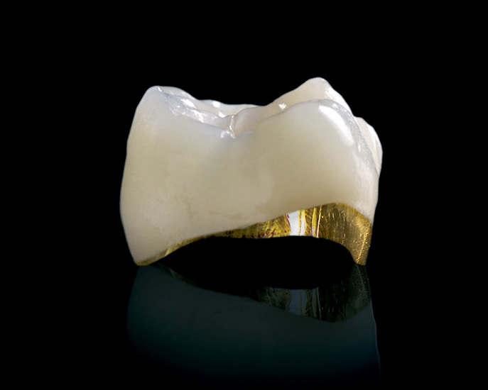 Металлокерамика на золоте (96% золота + премиальная керамика "GC Initial Premium"). Золотой край располагается со стороны языка/ неба.