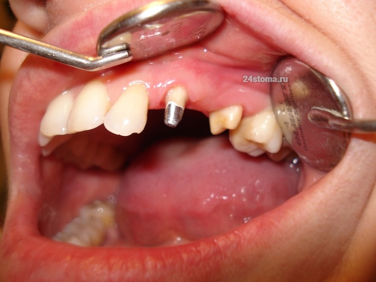 Исходная ситуация - отсутствует 24 зуб (23 и 25 зубы подготовлены в качестве опор мостовидного протеза) 