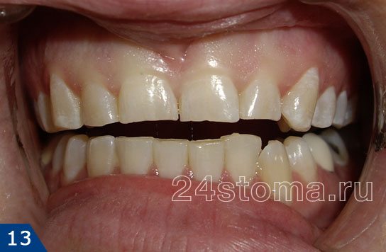 Повышенная стираемость зубов: снижение высоты коронок передних верхних зубов на 1/4