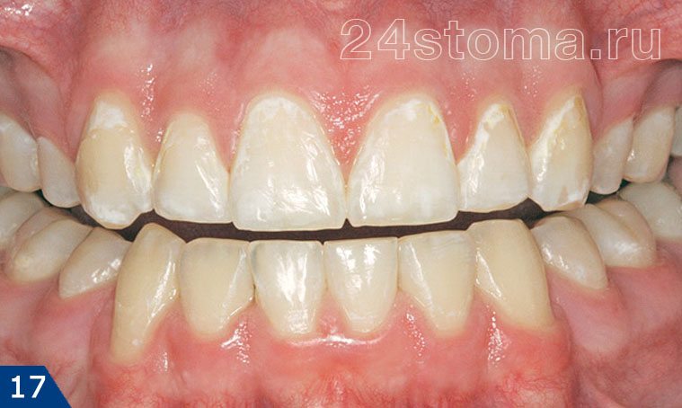 Многочисленные деминерализованные участки эмали в виде белых пятен у шеек зубов