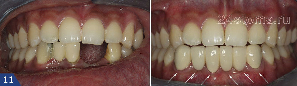 Металлокерамический мостовидный протез на 6 передних нижних зубов - фото до и после