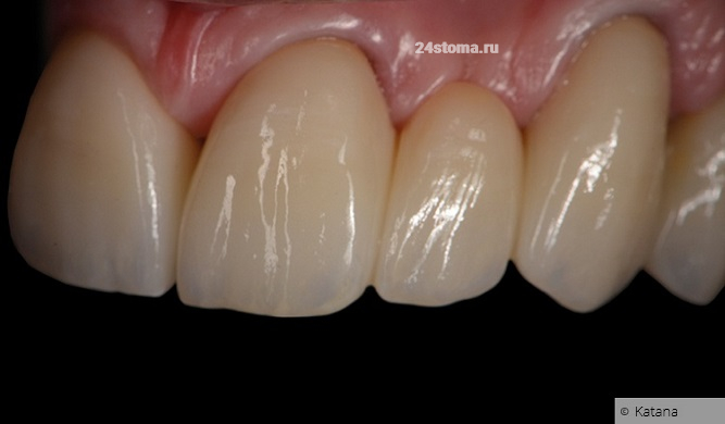 На всех зубах на этом фото - стоят искусственные коронки из монолитного диоксида циркония «Katana» (Multi-layer)